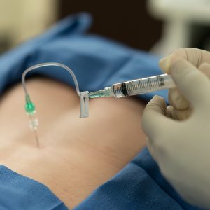 stem cell therapy