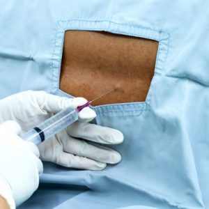 Nerve Block