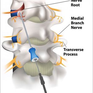 stem cell for knees, uses of stem cells, stem cell surgery, stem cell treatment for knees