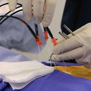 Radiofrequency Neurotomy