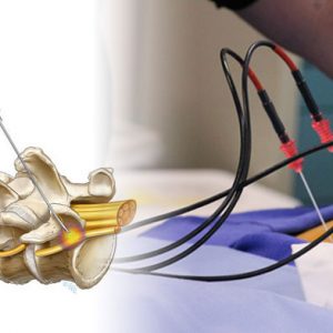 Radiofrequency Neurotomy
