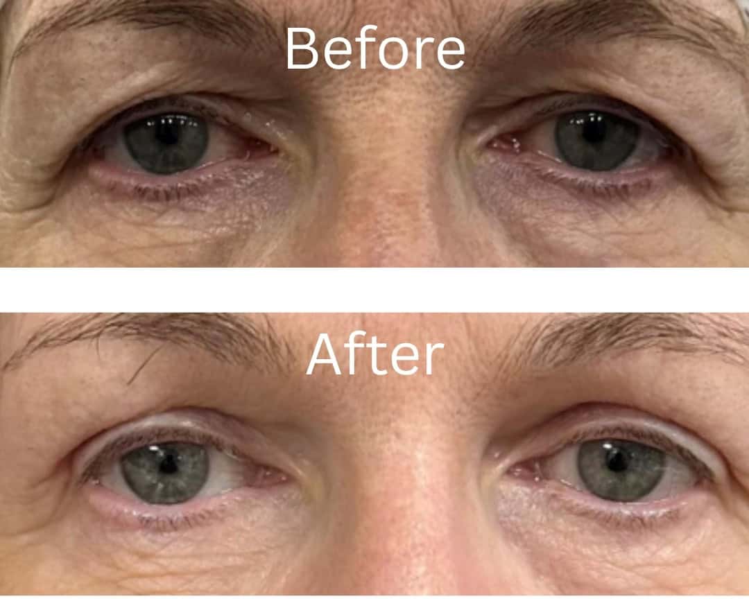 Blepharoplasty 1.Jpg