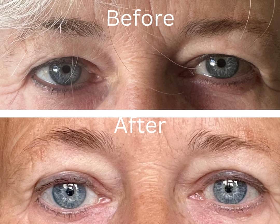 Blepharoplasty.jpg