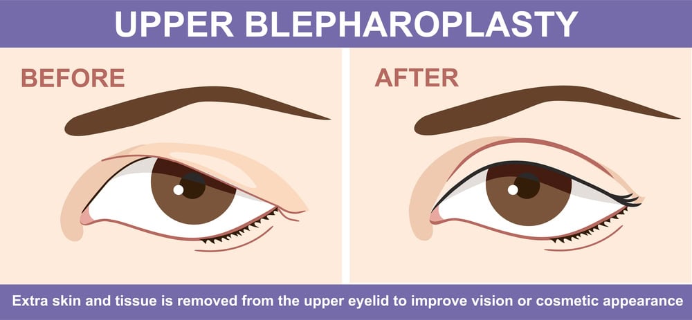 Eyelid Surgery 1.Jpg