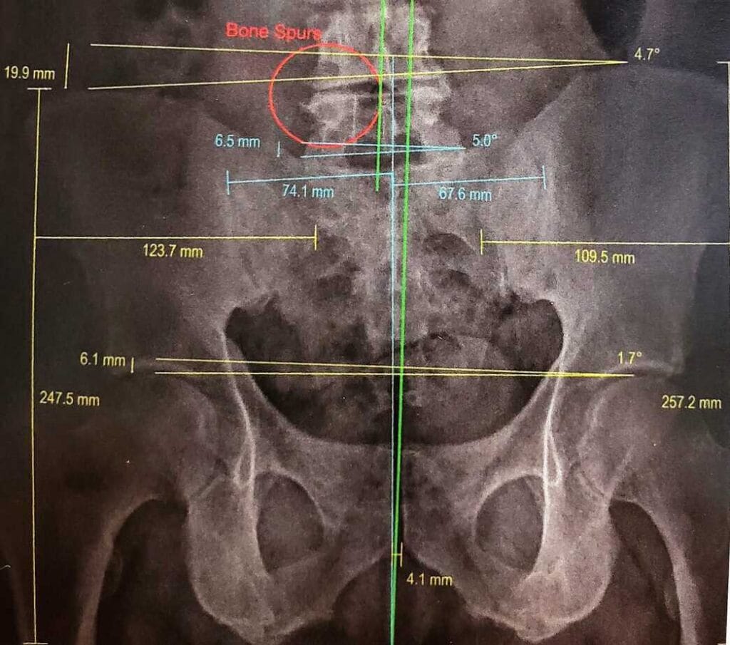 Alter, precise measurements of the pelvic bones and spine in a diagnostic X-ray.