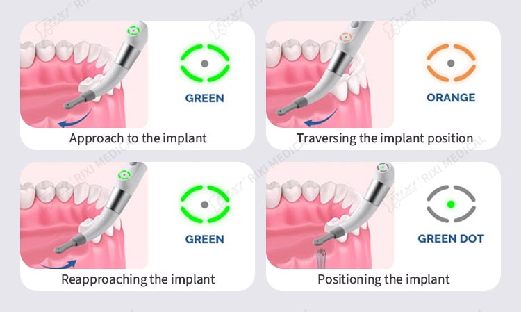 dental implant locator detail image 3