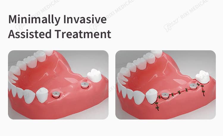 dental implant locator detail image 4