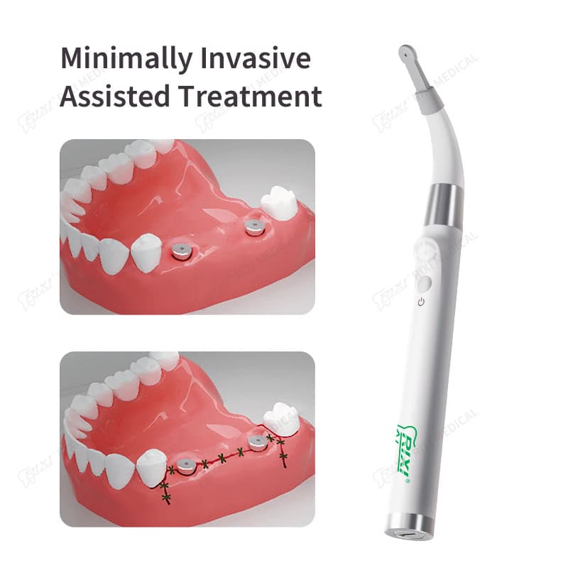 Dental Implant Locator for Precise Implant Positioning main image 6