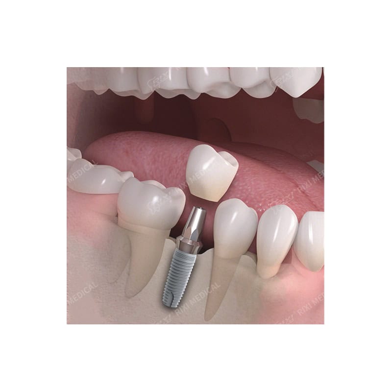 Titanium Dental Implant Fixture with Threaded Root Form main image 6