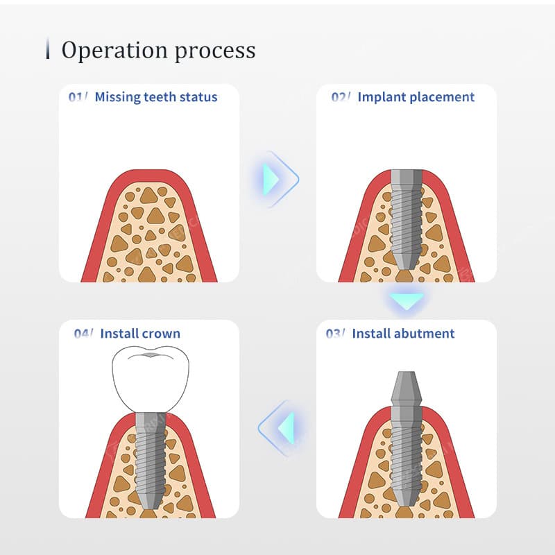 Titanium Dental Implant Fixture with Threaded Root Form main image 7