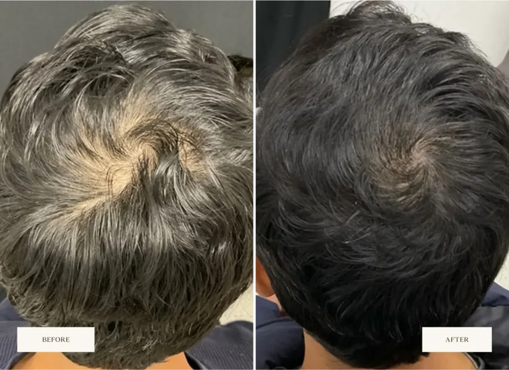 Before and After Male scalp treatment