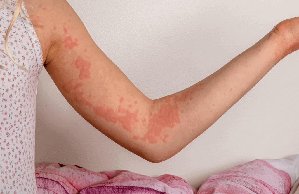 Skin rash on arm, allergic skin reaction, dermatitis, health treatment.