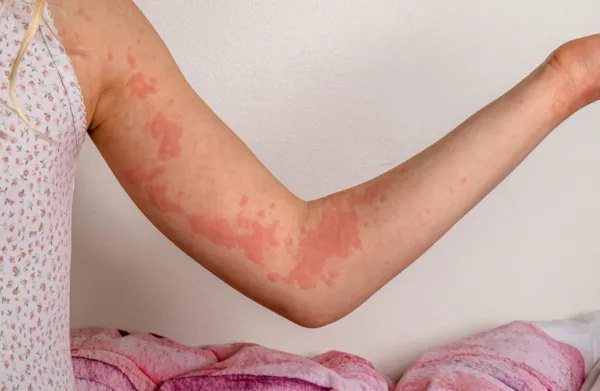 Urticaria