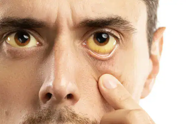 Close-up of a man with eye irritation, seeking treatment at Sukh Sagar Dawakhana.