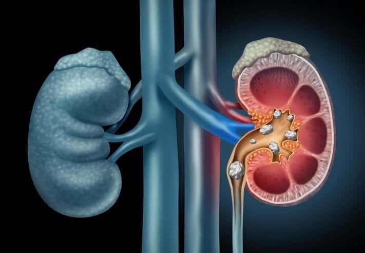 Detailed illustration of kidney and urinary system with kidney stones.