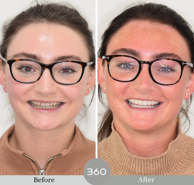 Porcelain veneers transformation at 360 Dental Care Manchester