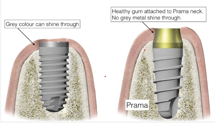 Prama dental implant showing the gum-attaching neck design