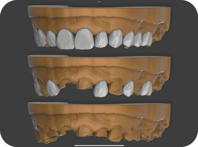 3D digital model of teeth used to plan the proposed smile design