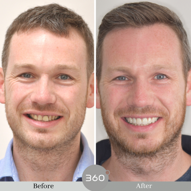 Before and after : 
