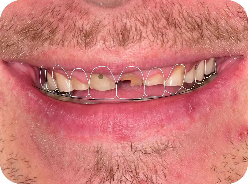Digital smile design overlay showing the simulation of the patient's final smile result
