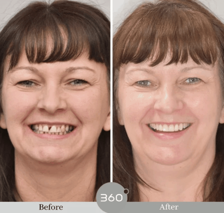 Before and after : 