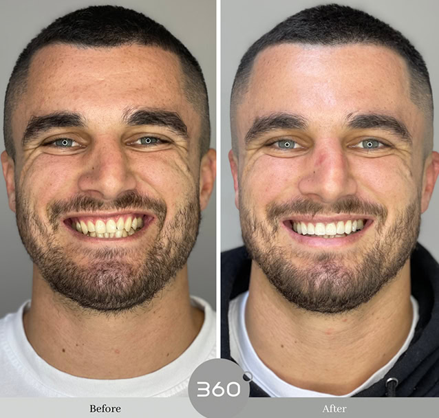 Before and after : 