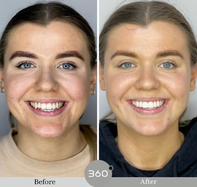 Before and after : 