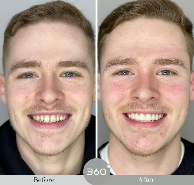 Before and after : 