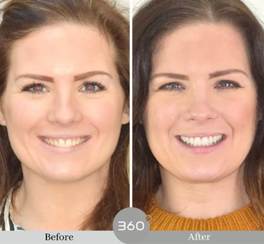 Before and after : 