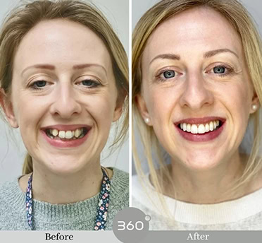 Before and after : 