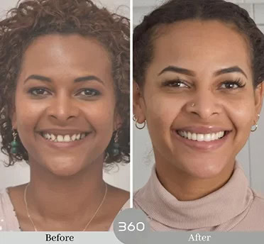 Before and after : 