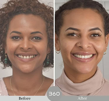 Before and after : 