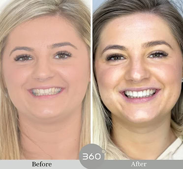 Before and after : 