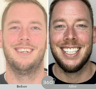 Before and after : 