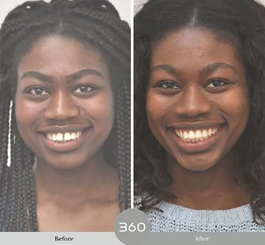 Before and after : 