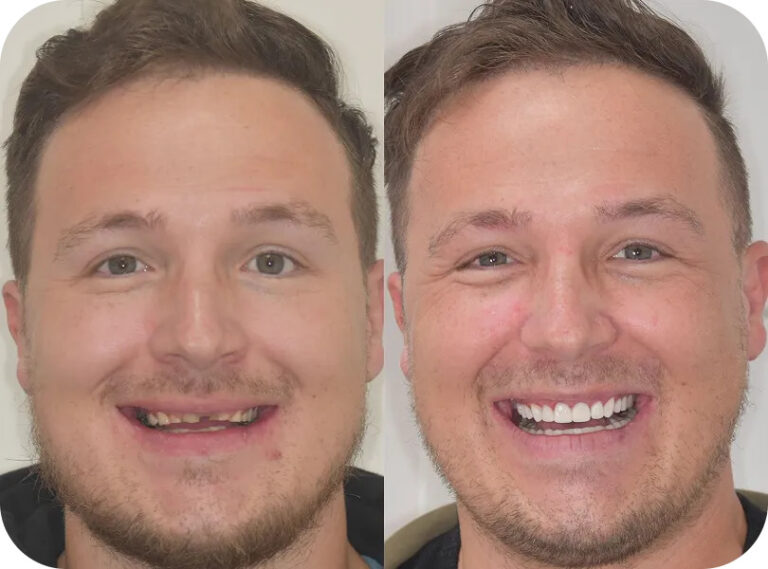Before and after : 