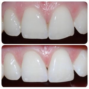 before and after of small chips to front teeth