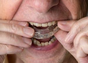 Custom Night Splints for Teeth Grinding: What to Expect