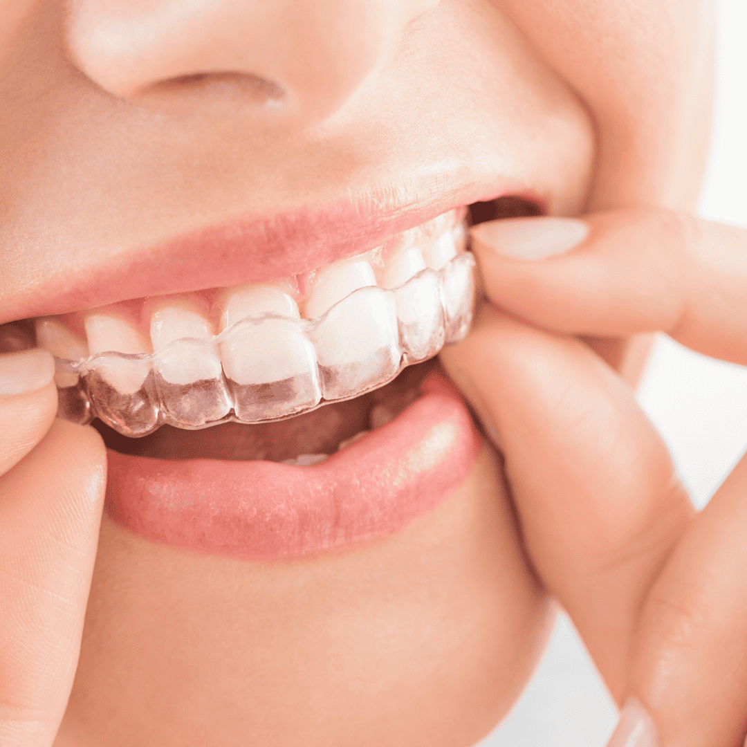 teeth whitening brisbane city