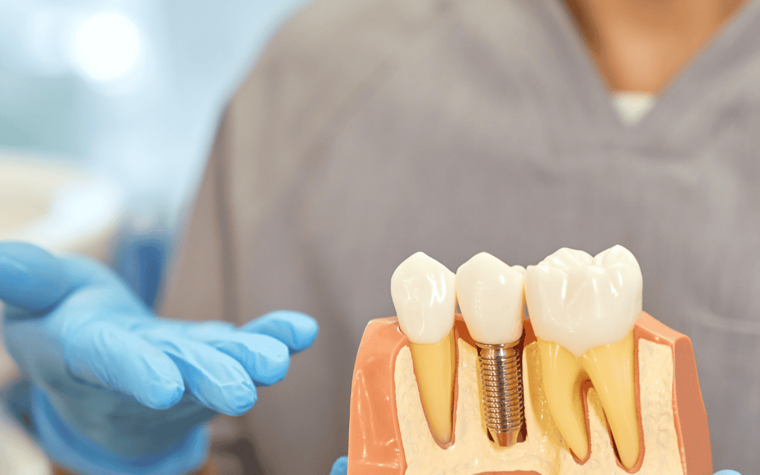 Thinking About Dental Implants? A Clear, Realistic Guide Before You Decide