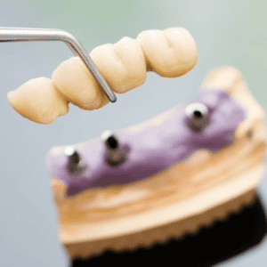 Brisbane Dental implants