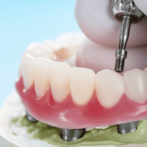 fixed bridge being screwed on to implants in brisbane CBD