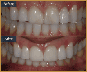veneers brisbane