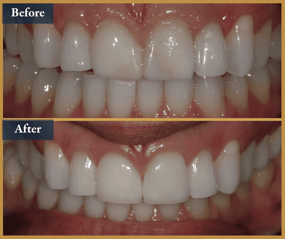 veneers brisbane
