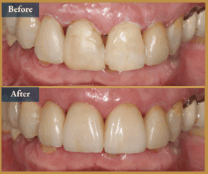 veneers brisbane