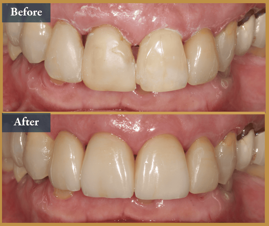 veneers brisbane