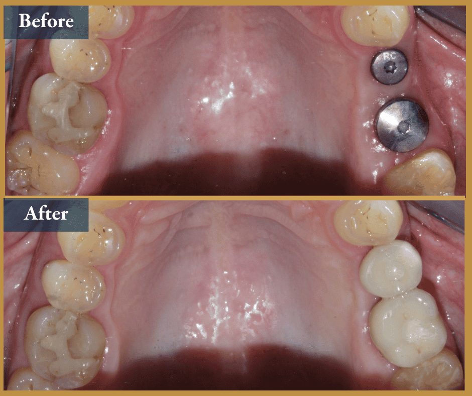 dental implant brisbane
