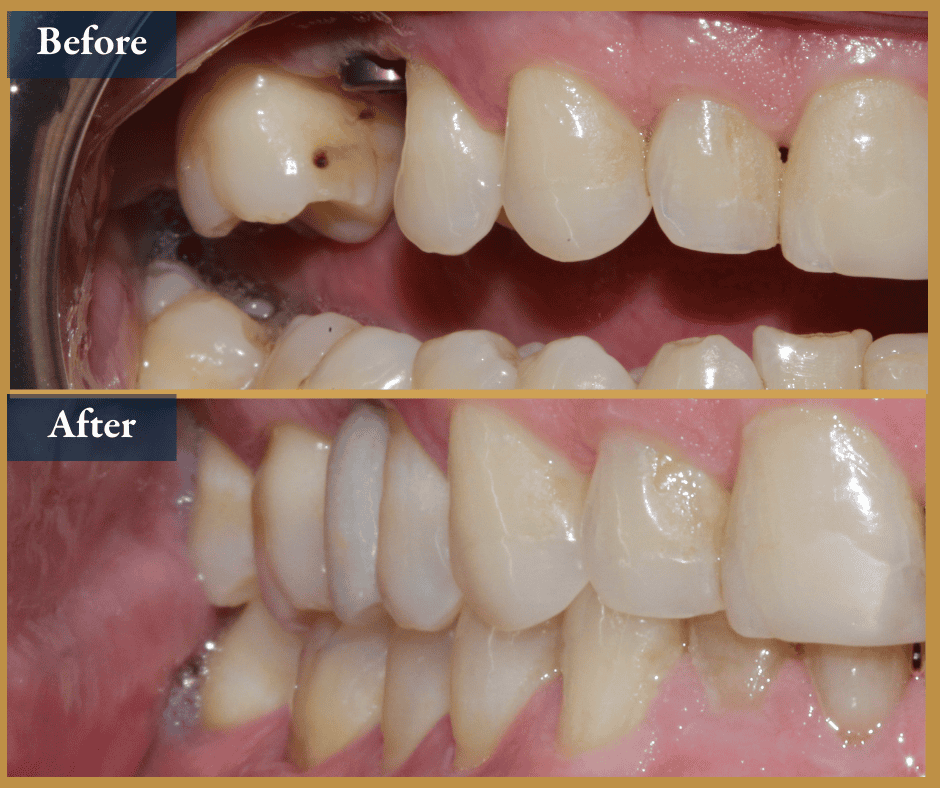 dental implant brisbane
