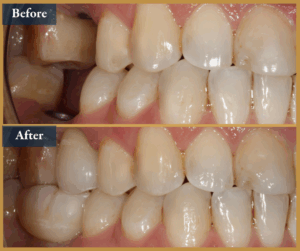 dental implant brisbane