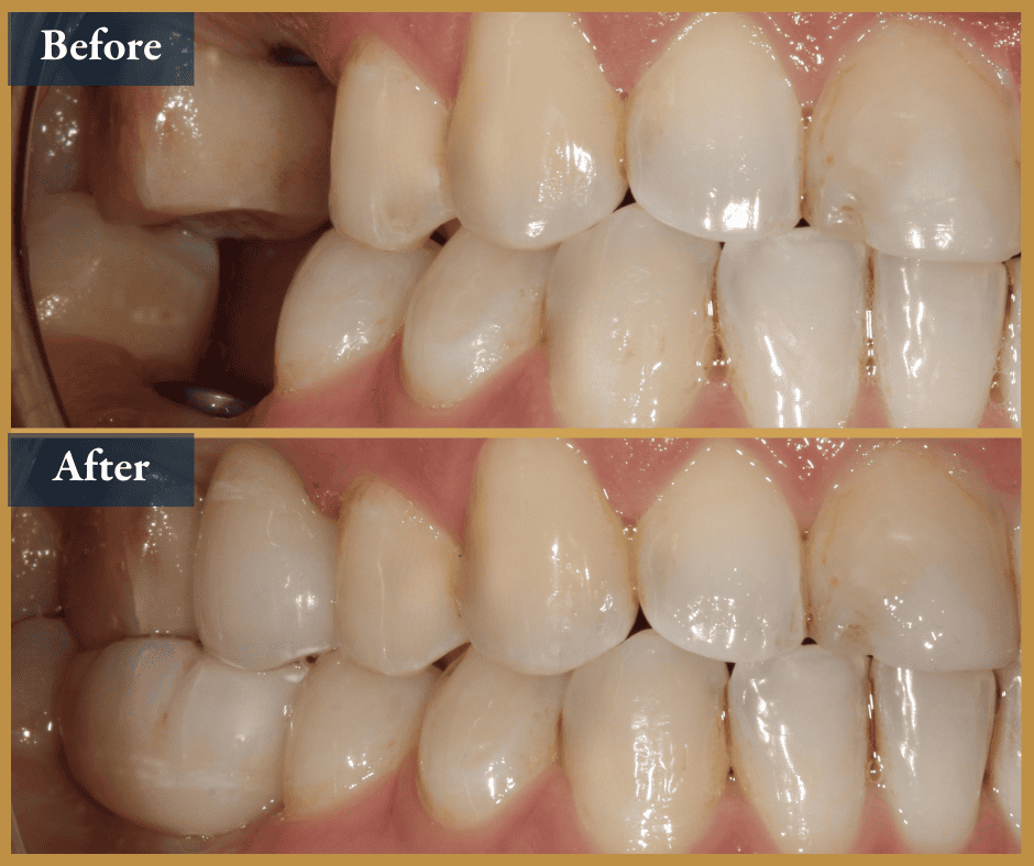 dental implant brisbane